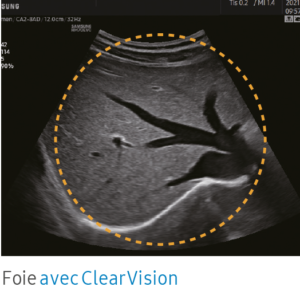 échographie foie avec échographe samsung HM70 EVO
