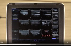 tutoriel échographe portatif samsung HM70 EVO mode sonoview