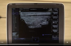 Tutoriel échographe portatif Samsung HM70EVO mesures