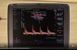 tutoriel Doppler échographe portable samsung HM70EVO