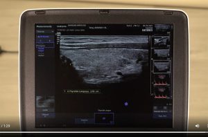 tutoriel échographe samsung HM70 EVO mesures protocolaires echographie