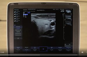 tutoriel échographe portable samsung HM70 EVO