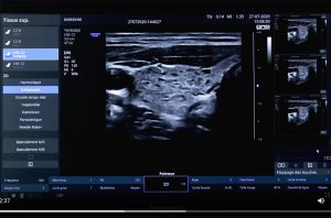 tutoriel échographe samsung HS30 2D