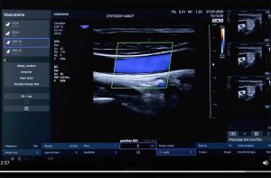 Tutoriel échographe Samsung HS30 Doppler couleur