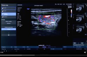 Tutoriel échographe Samsung HS30 Doppler puissance