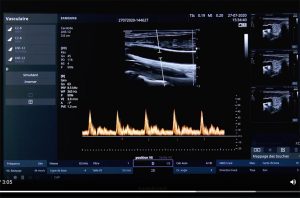 tutoriel échographe samsung HS30 PW