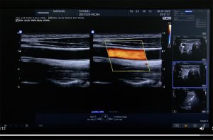 Tutoriel échographe Samsung HS40 Doppler couleur