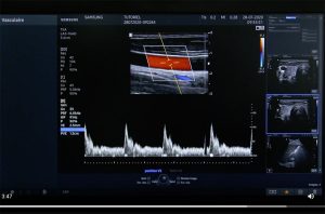 Tutoriel échographe samsung HS40 PW