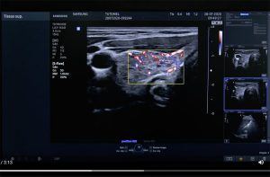 Tutoriel échographe Samsung HS40 Doppler Puissance