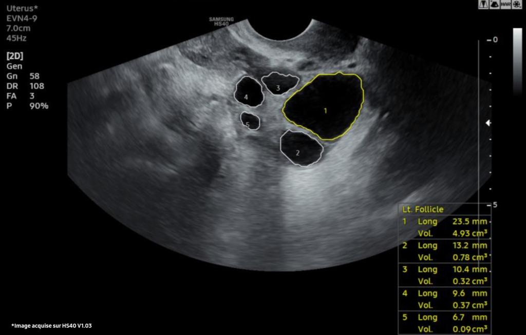 Echographe Samsung 2D Follicle