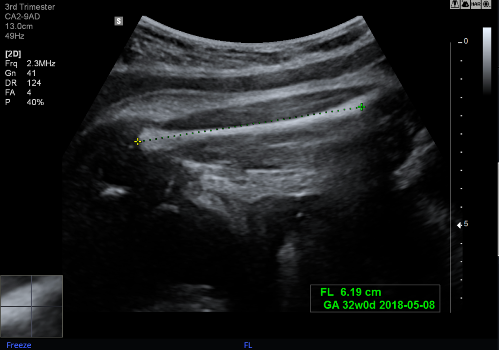 Echographe Samsung HS50 Biometry Assist