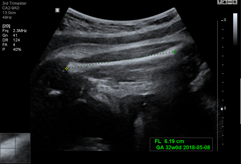 Echographe Samsung HS50 Biometry Assist
