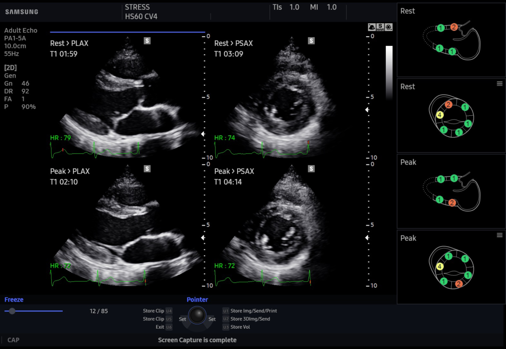 Echographe Samsung HS60 Stress Echo