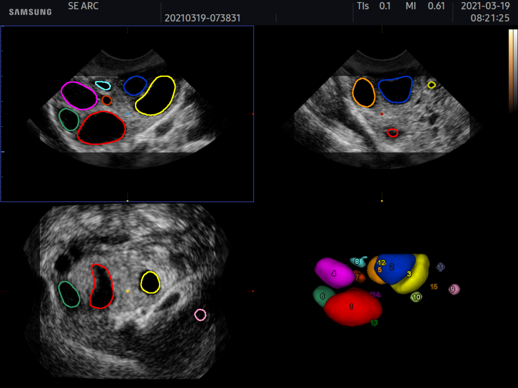 5D follicle échographe Samsung HS40
