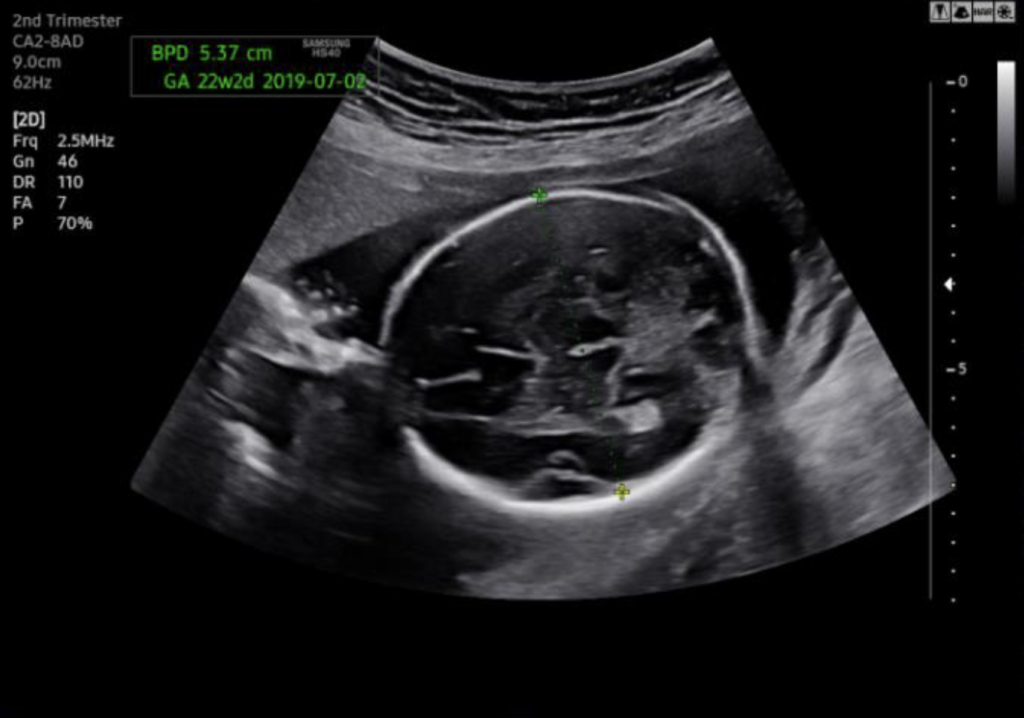 Echographe Samsung HS30 Biometry Assist