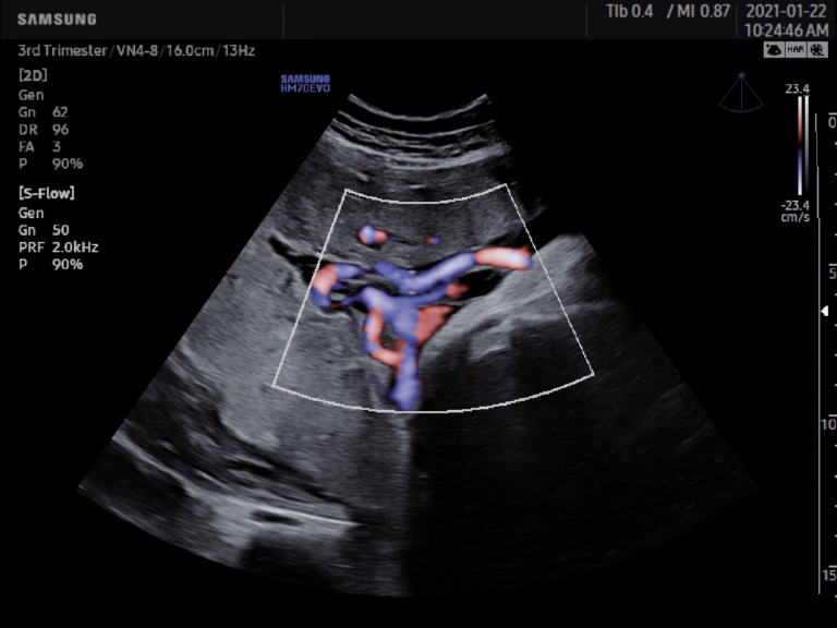Samsung HM70 EVO Cordon ombilical Doppler puissance