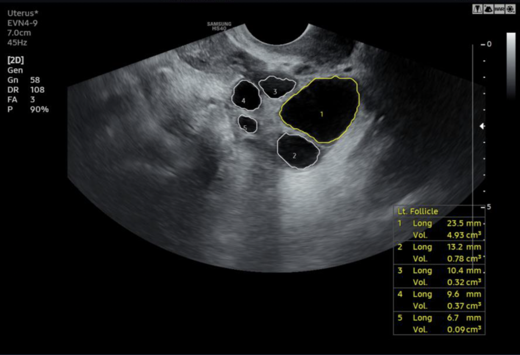 2D follicle échographe Samsung HS40