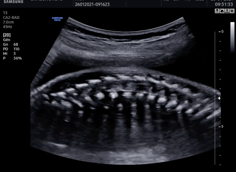 Rachis foetal en mode 2D