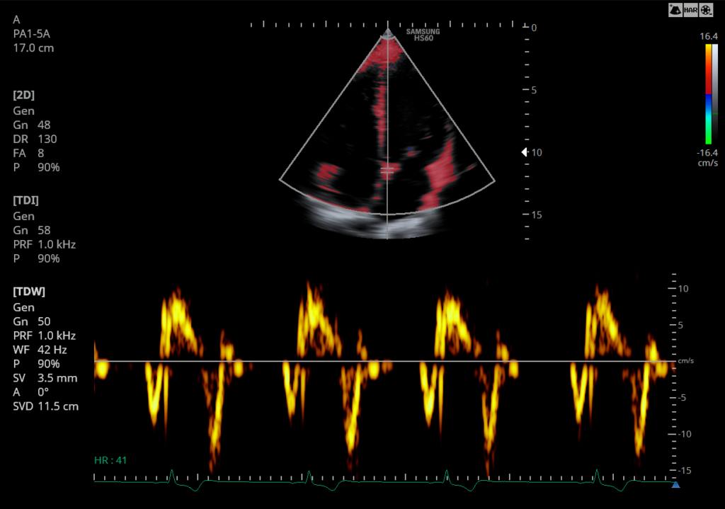 Doppler tissulaire Echographe Samsung HS50