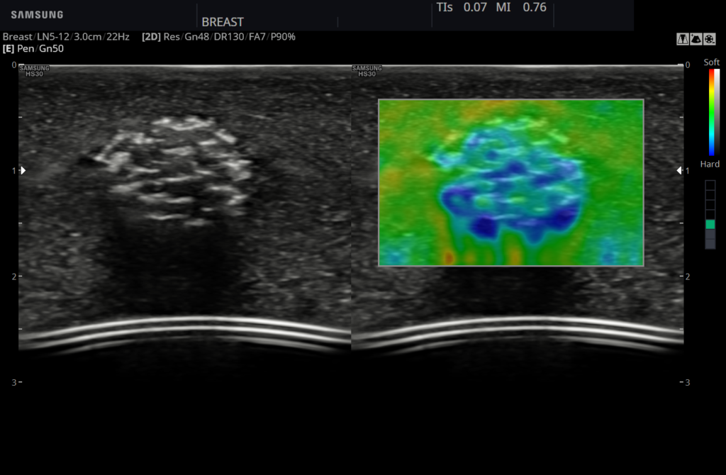 Echographe Samsung HS30 Elastoscan