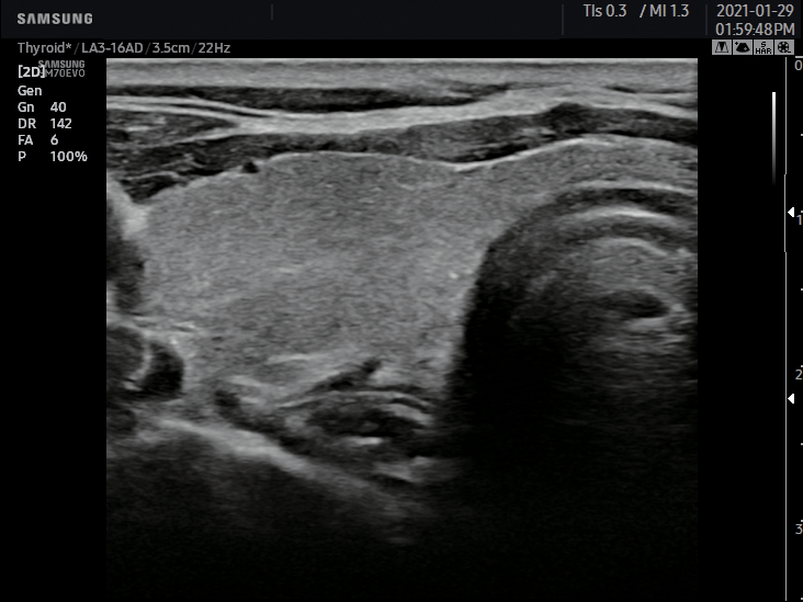 Thyroide 2D échographe Samsung HM70 EVO