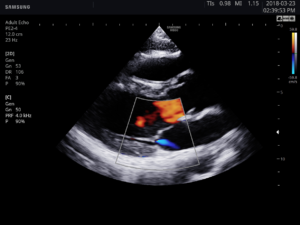 Echographe Samsung HS50 Cardio Doppler C