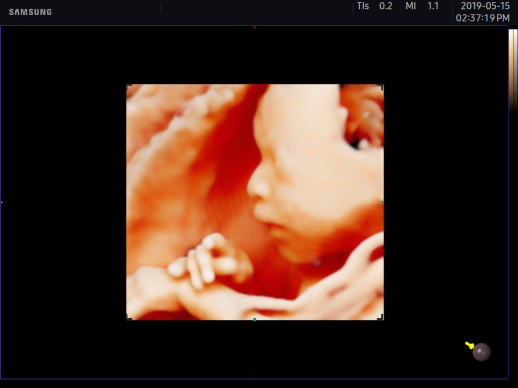 Echographe Samsung HS60 Realistic Vue