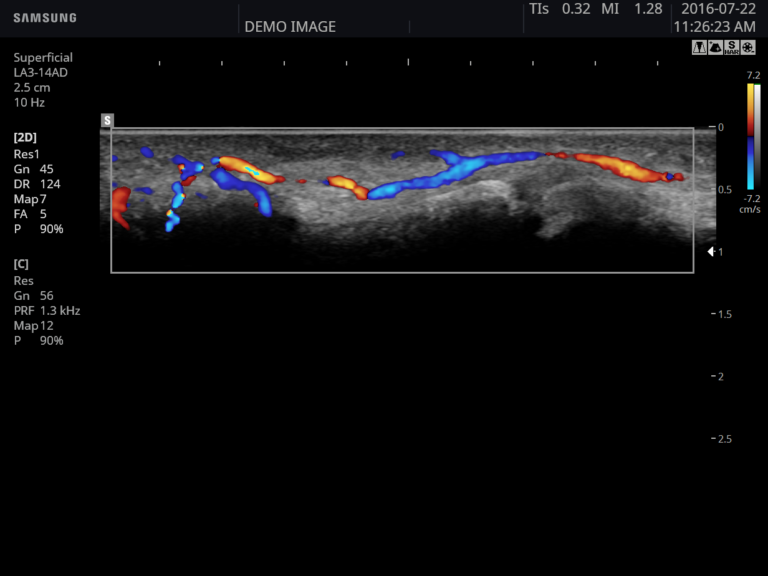 Echographe Samsung HS50 doigt Doppler C