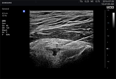 échographe bloc opératoire samsung needle mate