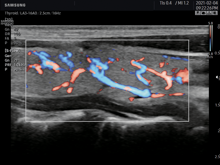 Thyroide S Flow échographe Samsung HM70 EVO