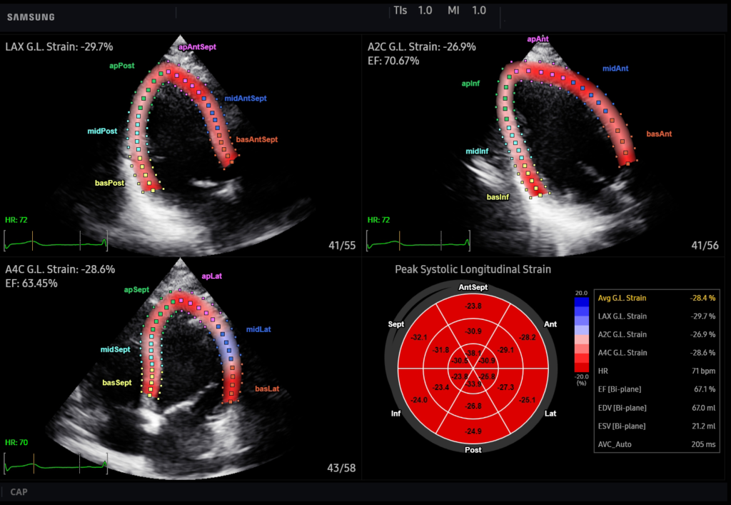Strain+ Echographe HS50