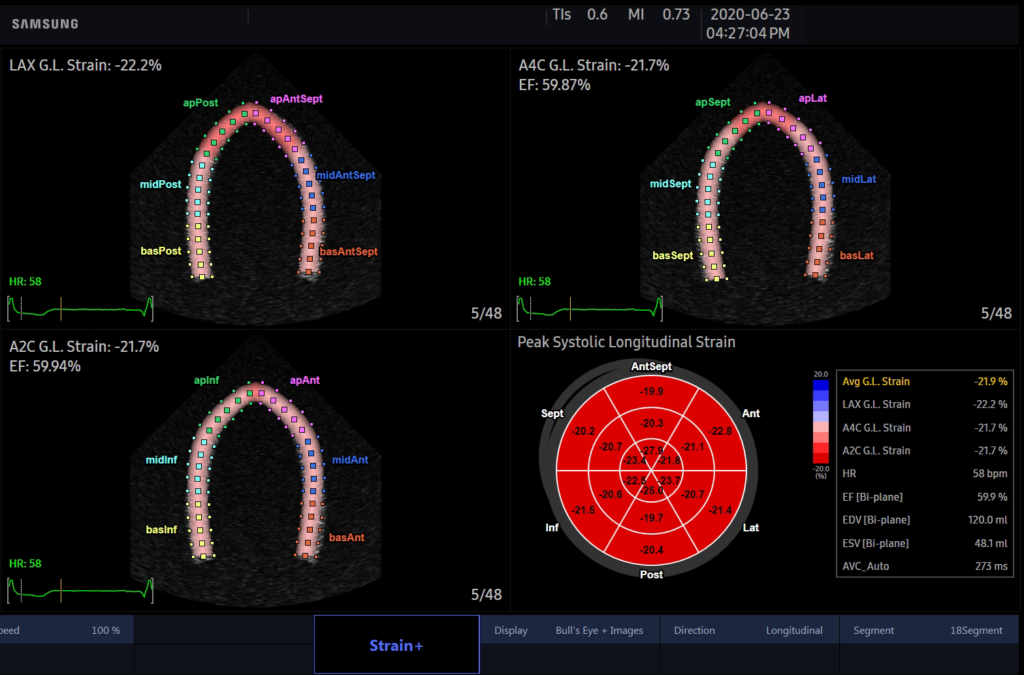 Echographe Samsung HS30 Strain+