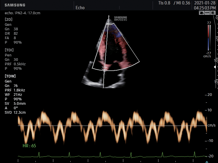 Doppler tissulaire échographe Samsung HM70 EVO