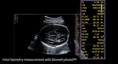 Mesure biométries foetales biometry Assist Samsung