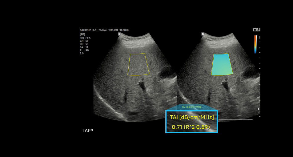 échographe gastro-entérologie Samsung technologie TAI évaluation de la stéatose