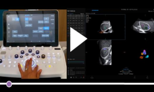tutoriel échographie comptage folliculaire 3D Samsung 5D Follicle
