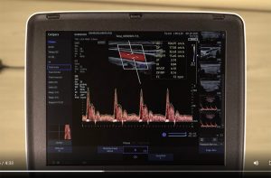 tutoriel Doppler échographe portable samsung HM70EVO