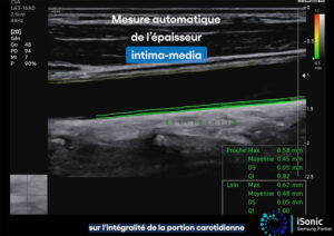 auto IMT échographe samsung