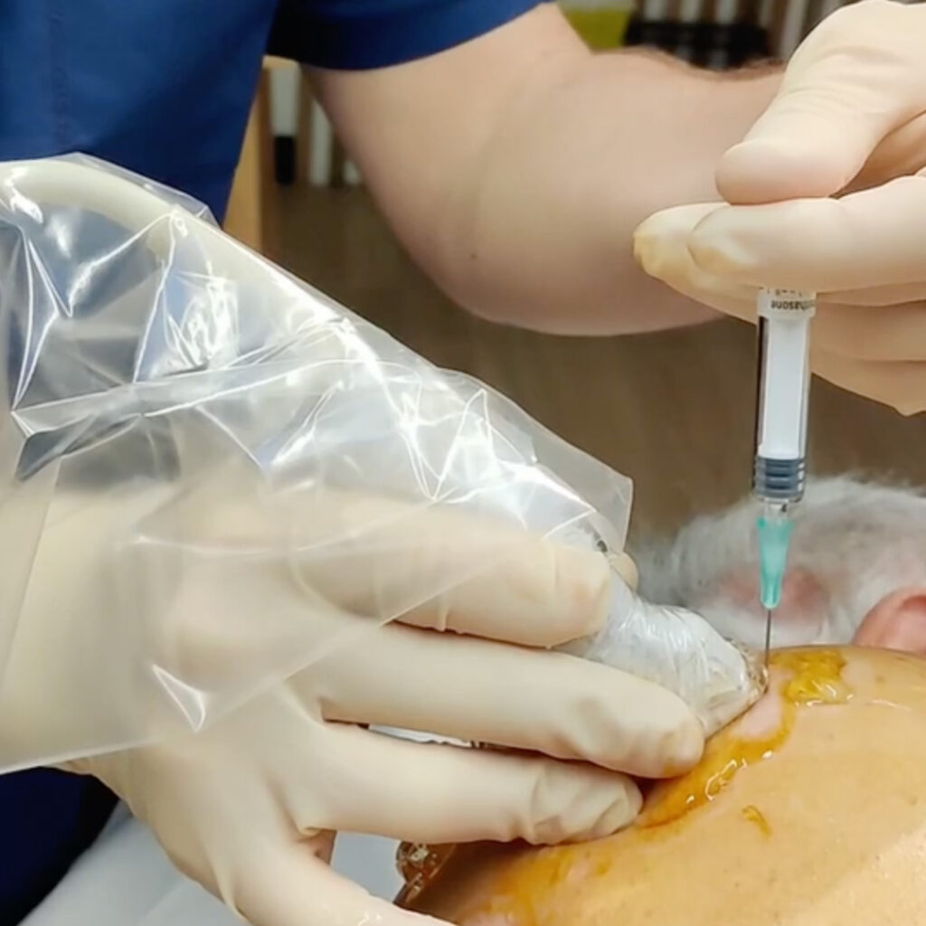 echographie interventionnelle et rhumatologie avec jimmy gross et sonoschool