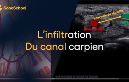 infiltration canal carpien echographie sonoschool jimmy gross