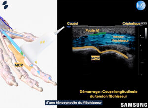 infiltration doigt echographie sonoschool