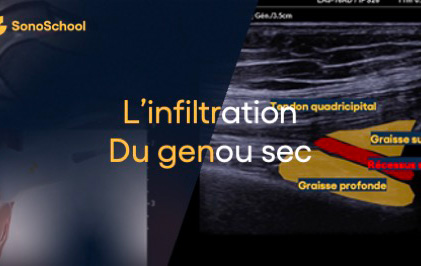 infiltration du genou en echographie sonoschool jimmy gross