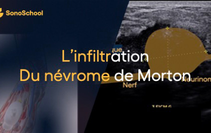 infiltration nevrome de morton en echographie rhumatologie sonoschool jimmy gross