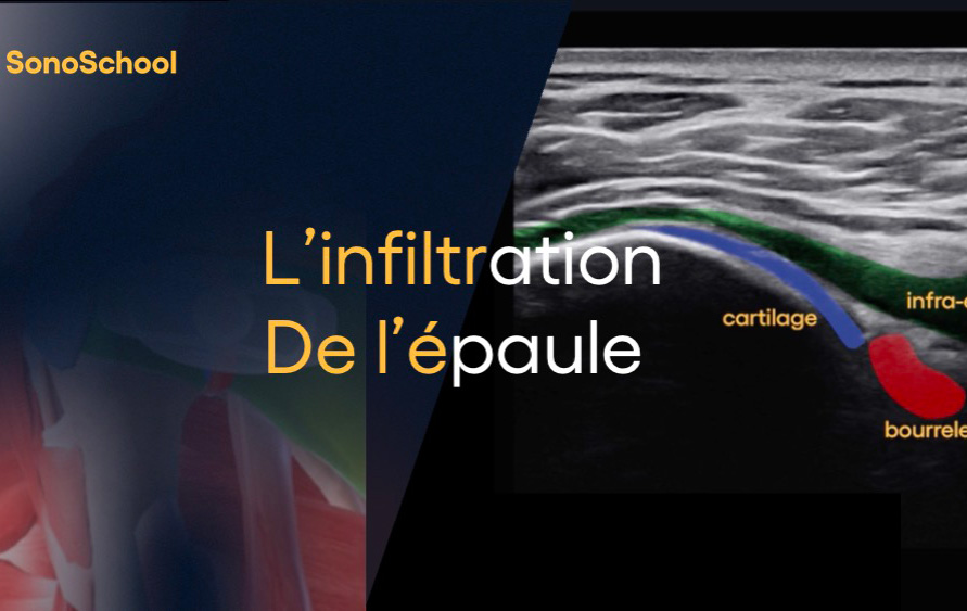 infiltration_epaule_echographie_sonoschool