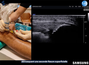 injection_prp_genou_echographie_sonoschool_jimmy_gross