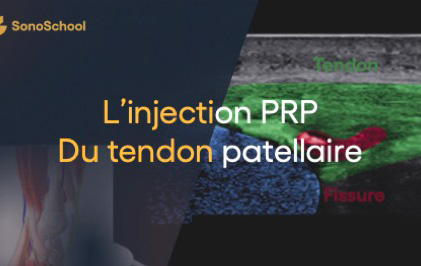 injection prp tendon rhumatologie sonoschool jimmy gross
