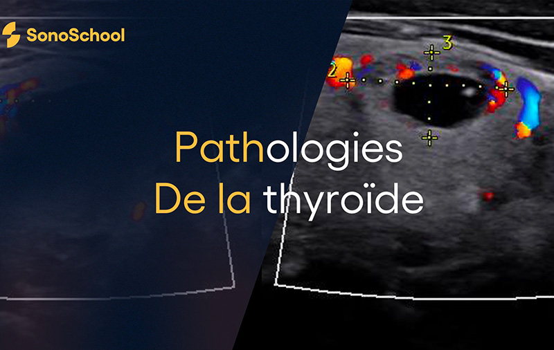 formation echographie thyroide les principales pathologies
