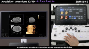 tutoriel echographie 3D samsung v7