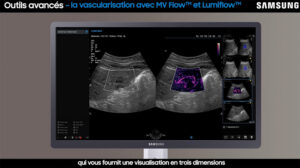 tutoriel echographie MV Flow samsung V7
