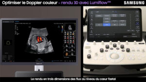 tutoriel echographie doppler couleur samsung v7